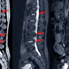 Obraz MRI kręgosłupa lędźwiowego z widocznymi zwężeniami kanału kręgowego (stenoza kanału kręgowego) zaznaczonymi czerwonymi strzałkami.