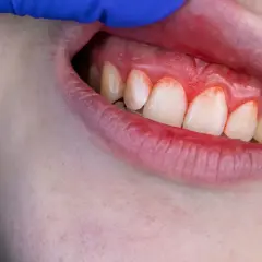 Encías inflamadas y rojas, indicando la necesidad de un tratamiento para encías sangrantes.