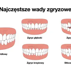 Zgryz prawidłowy to idealne ułożenie zębów. Obok wady zgryzu: głęboki, otwarty, krzyżowy i stłoczenia.