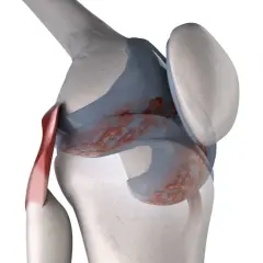 Dettaglio anatomico del ginocchio con lesioni cartilaginee e tendine rosso. Il ginocchio che scricchiola quando lo stendo potrebbe essere causato da questo.