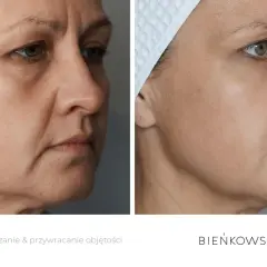 Przed i po zabiegu lipotransferu. Widoczne wygładzenie skóry i przywrócenie objętości twarzy.