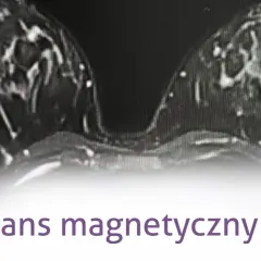 Mammografia czy rezonans - która metoda diagnozy raka piersi jest lepsza?