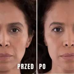 Przed i po zabiegu z użyciem kwasu polimlekowego pod oczy. Skóra wokół oczu jest gładsza, cienie zredukowane.