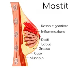 Illustrazione anatomica del seno che mostra infiammazione e rossore, sintomi comuni di dolore al seno durante l'allattamento.