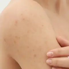 Widoczne grudki pod skórą na ramieniu, które mogą być objawem problemów dermatologicznych.