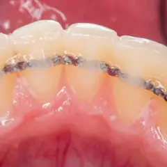 Metalowy retainer po polsku, umieszczony na zębach, utrzymuje je w idealnym ułożeniu po leczeniu ortodontycznym.