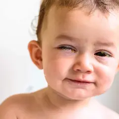 Ein Baby mit einem geschwollenen Augenlid einseitig. Gelbliche Verkrustungen am Auge. Hausmittel könnten helfen.