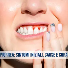 Gengive sanguinanti, un sintomo iniziale della piorrea. Scopri le cause e come curarla.