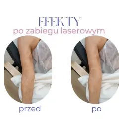 Przed i po zabiegu laserowym: widoczne ciemne blizny na nogach stają się jaśniejsze i mniej widoczne.