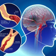 PFO objawy neurologiczne: Jak unikać ryzyka udaru mózgu?