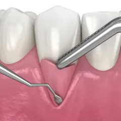 Instrumentos dentales trabajan en la encía, mostrando cómo las encías se regeneran para una sonrisa saludable.