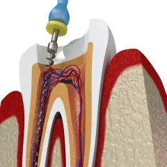 Instrumento dental limpia conducto radicular afectado por caries avanzada. Se aprecian vasos sanguíneos y nervios.