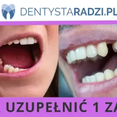 Usta z brakami zębowymi po lewej i prawej stronie. Widoczny problem z uzupełnieniem 1 zęba, który wymaga odbudowy.