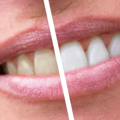 Prima e dopo: denti ingialliti e con placche, poi bianchi e splendenti. Un sorriso trasformato.