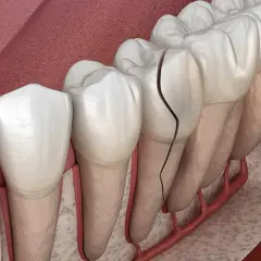 Dente con evidente crepe smalto, che si estende dalla corona alla radice, mostrando la vulnerabilità della struttura dentale.