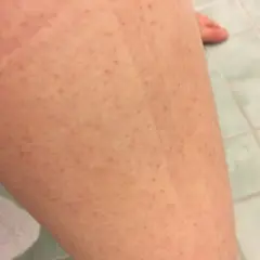 Närbild på hud med små prickar, liknande jordgubbsben. En bit av en vit handduk syns i bakgrunden.
