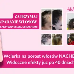 Wcierki do włosów: Czy działają? Składniki, efekty i jak stosować