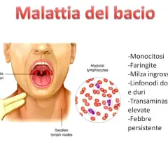 Malattia del bacio: sintomi come faringite, linfonodi dolenti, febbre persistente e monocitosi.