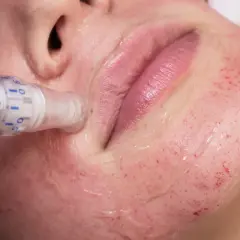 Zabieg derma peel na twarzy, widoczne drobne nakłucia i zaczerwienienie skóry.