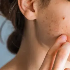 Nahaufnahme einer jungen Frau, die mit dem Finger über ihre Wange streicht, auf der rote und braune Flecken sichtbar sind, die auf Stresspickel hindeuten.