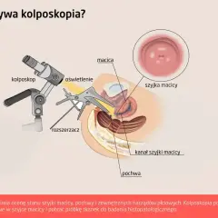 Ilustracja pokazuje, co to kolposkopia: badanie szyjki macicy kolposkopem, rozszerzaczem i oświetleniem.