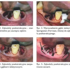 Krwawienie po wyrwaniu zęba: ile trwa i kiedy szukać pomocy?
