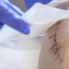 Ręka w niebieskiej rękawiczce delikatnie dotyka opatrunku na skórze, ukazując ślady po zabiegu, które mogą sugerować martwicę po lipolizie.