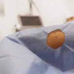 Skóra pacjenta przygotowana do zabiegu dermatochirurgii. W tle sprzęt medyczny.