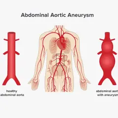 Aneurysma Symptome Bauch: Warnsignale, die Sie nicht ignorieren sollten