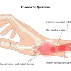 Zapalenie ścięgien kciuka w stawie nadgarstka, powodujące ból i obrzęk.