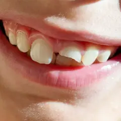 ¡Ay, se me ha caído un diente! ¿Qué hago? La sonrisa de un niño con un diente roto y un espacio vacío.