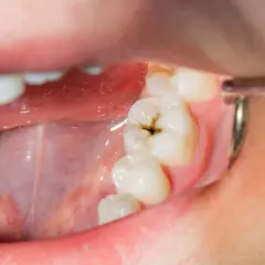 Boca abierta mostrando un diente con caries. El dentista examina la cavidad oscura en el molar.