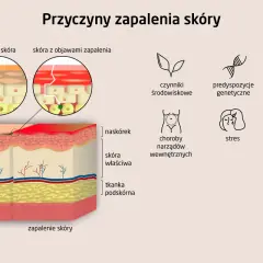 Ilustracja porównuje zdrową skórę z zapaloną, pokazując zmiany w naskórku. Wymienia też przyczyny zapalenia skóry, w tym krostkowe zapalenie skóry.