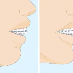 Perfil de una boca con ortodoncia. A la izquierda, se muestra una sobremordida severa. A la derecha, los dientes están alineados.