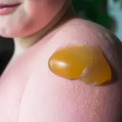 Nahaufnahme einer offenen Brandblase auf der Schulter eines Kindes. Die Blase ist mit klarer Flüssigkeit gefüllt und die Haut ist gerötet. Die richtige Behandlung einer offenen Brandblase ist wichtig.