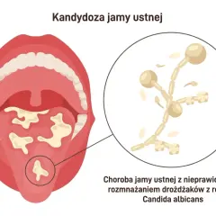 Ilustracja przedstawia jamę ustną z białymi nalotami na języku i podniebieniu, objawy grzybicy jamy ustnej. Powiększony fragment ukazuje drożdżaki Candida albicans.