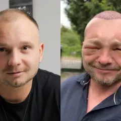 Mężczyzna po przeszczepie twarzy, z opuchniętymi powiekami i widocznymi śladami zabiegu na głowie.