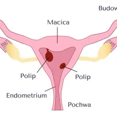 Schemat budowy macicy z widocznymi polipami w obrębie błony śluzowej macicy (endometrium).