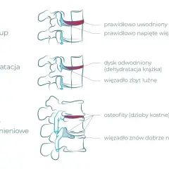 Ilustracja pokazuje postęp zwyrodnienia kręgosłupa lędźwiowego: od zdrowego dysku, przez jego odwodnienie, po zmiany zwyrodnieniowe z osteofitami.