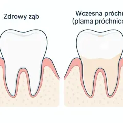 Porównanie zdrowego zęba i zęba z wczesną próchnicą. Czy próchnica boli? Na początku nie, ale plama próchnicowa to sygnał ostrzegawczy.