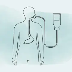 Stilisierte Darstellung eines Körpers mit Magensonde und Infusionsbeutel. Die Frage "wie lange kann man mit einer Magensonde leben" wird visuell thematisiert.
