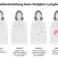 Illustrationen zeigen Stadien des Hodgkin-Lymphoms, von einem einzelnen befallenen Lymphknoten bis zu Befall mehrerer Organe. Symptome Lymphknotenkrebs können sich je nach Stadium ändern.