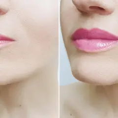 Przed i po zabiegu lip flip. Zobacz, jak zmieniły się usta i poznaj lip flip cenę.