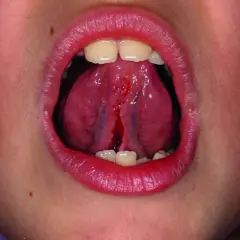 Bocca aperta con lingua che mostra un frenulo linguale corto e lacerato, con sanguinamento.
