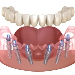 Implantes dentales en la mandíbula inferior, mostrando la integración del injerto óseo dental. Problemas de encía y hueso pueden afectar la estabilidad.