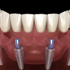 Arcata dentale fissa su quattro impianti dentali, una soluzione moderna per un sorriso completo.