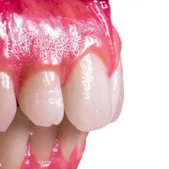 Primer plano de encías inflamadas y dientes, mostrando un posible epulis dental.