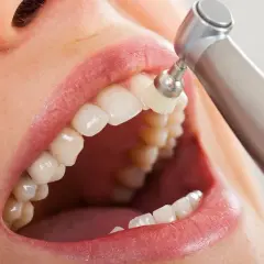 La pulizia dei denti con uno strumento rotante per un sorriso smagliante.