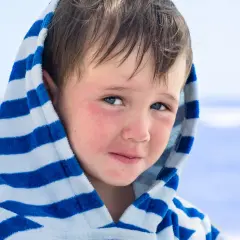 Bambino con guance arrossate, forse per la dermatite da sabbia, avvolto in un accappatoio a righe blu e bianche.