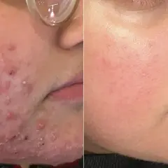 Före- och efterbilder visar hud med akne som blivit slät. En fin, rak mustasch kan nu framhävas.